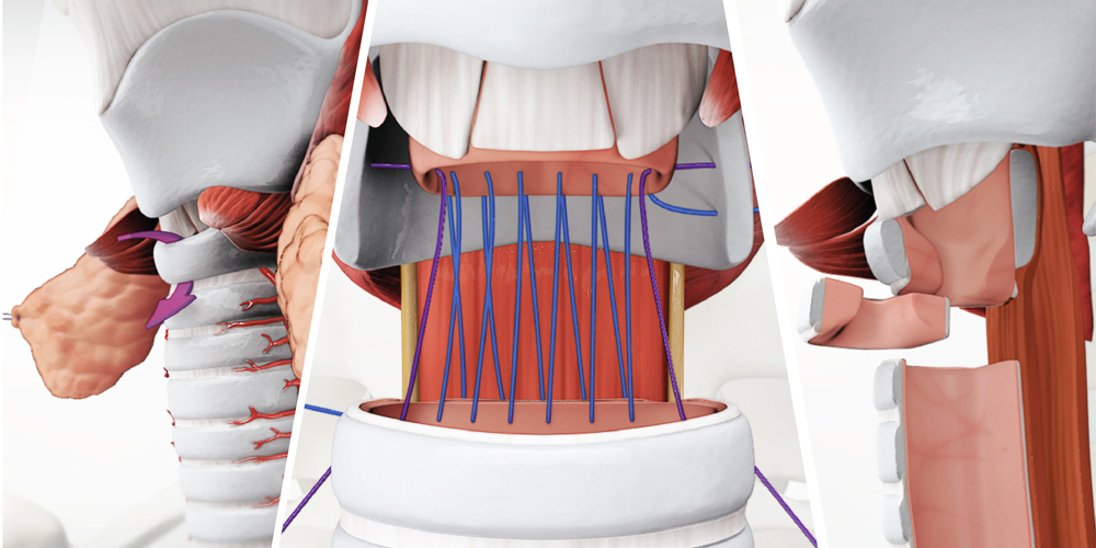 Tracheal Surgery in Hyderabad